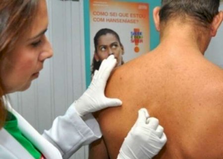 Capital reduz 9% dos casos de hansen&iacute;ase e preven&ccedil;&atilde;o &eacute; arma contra a doen&ccedil;a