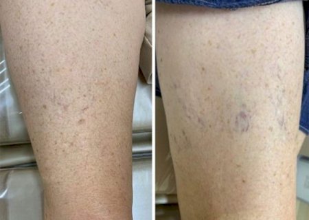 Secagem poderosa: Reduza os &lsquo;vasinhos&rsquo; e brilhe com a Royal Face
